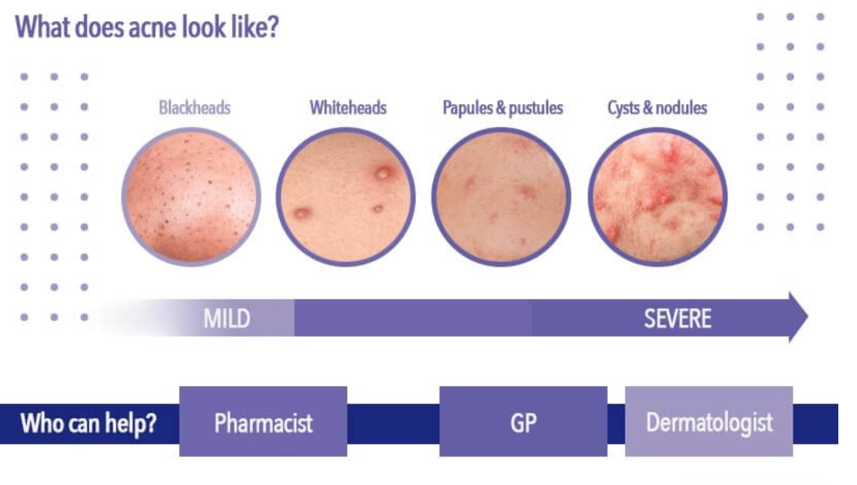 infographic depicting types of acne