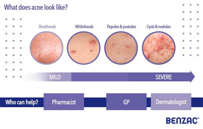 infographic depicting types of acne